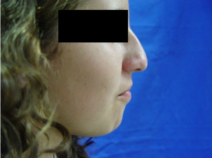 Cirugía de la Nariz