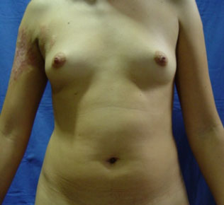 Mamoplastia de Aumento