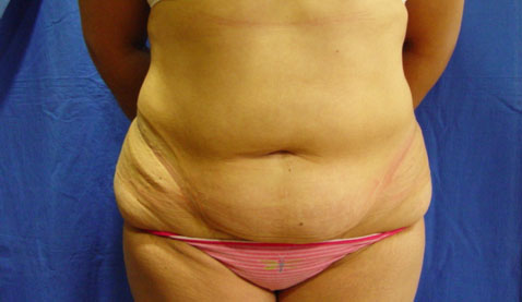 Abdominoplastia