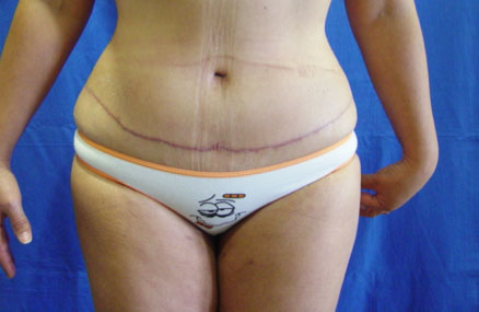 Estiramiento del Abdomen