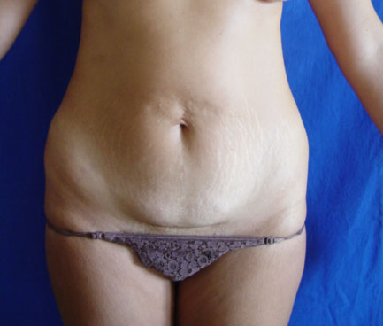 Abdominoplastia