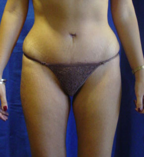 Estiramiento del Abdomen