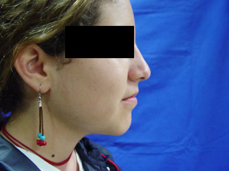 Resultado Rinoplastia