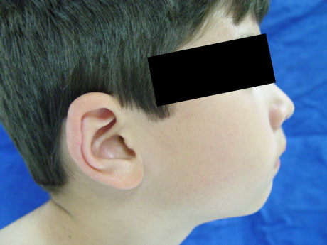 Cirugía de las Orejas Prominentes