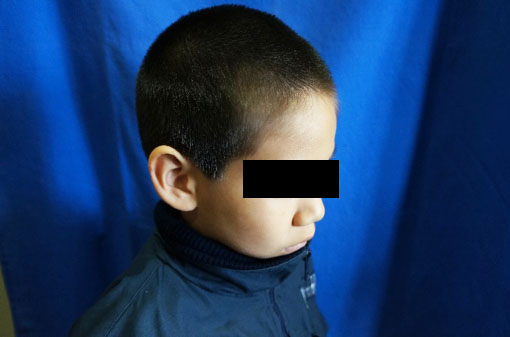 Cirugía de las Orejas de Ratón