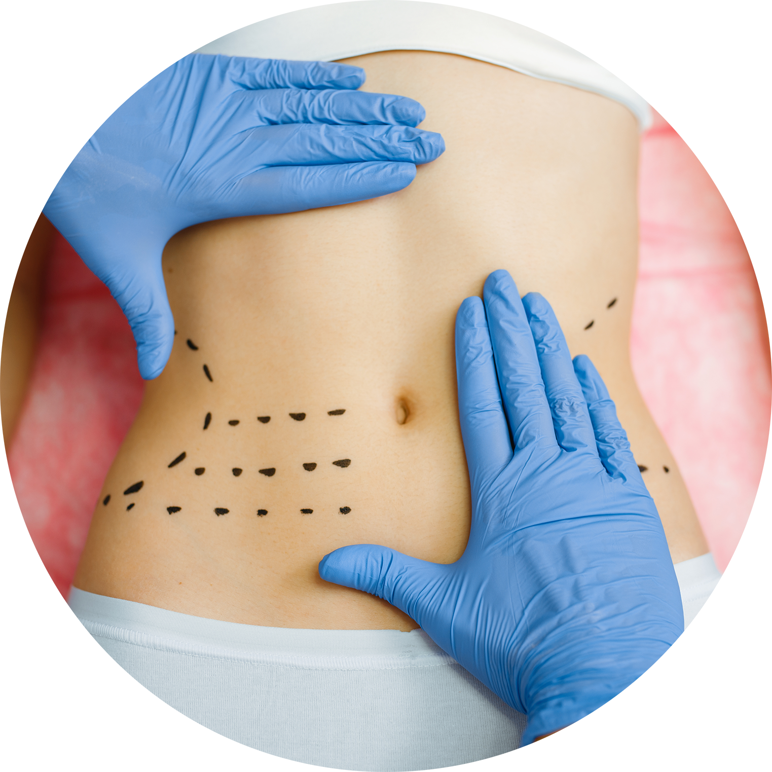 Abdominoplastia o Estiramiento del Abdomen Abdominoplastia o Estiramiento del Abdomen