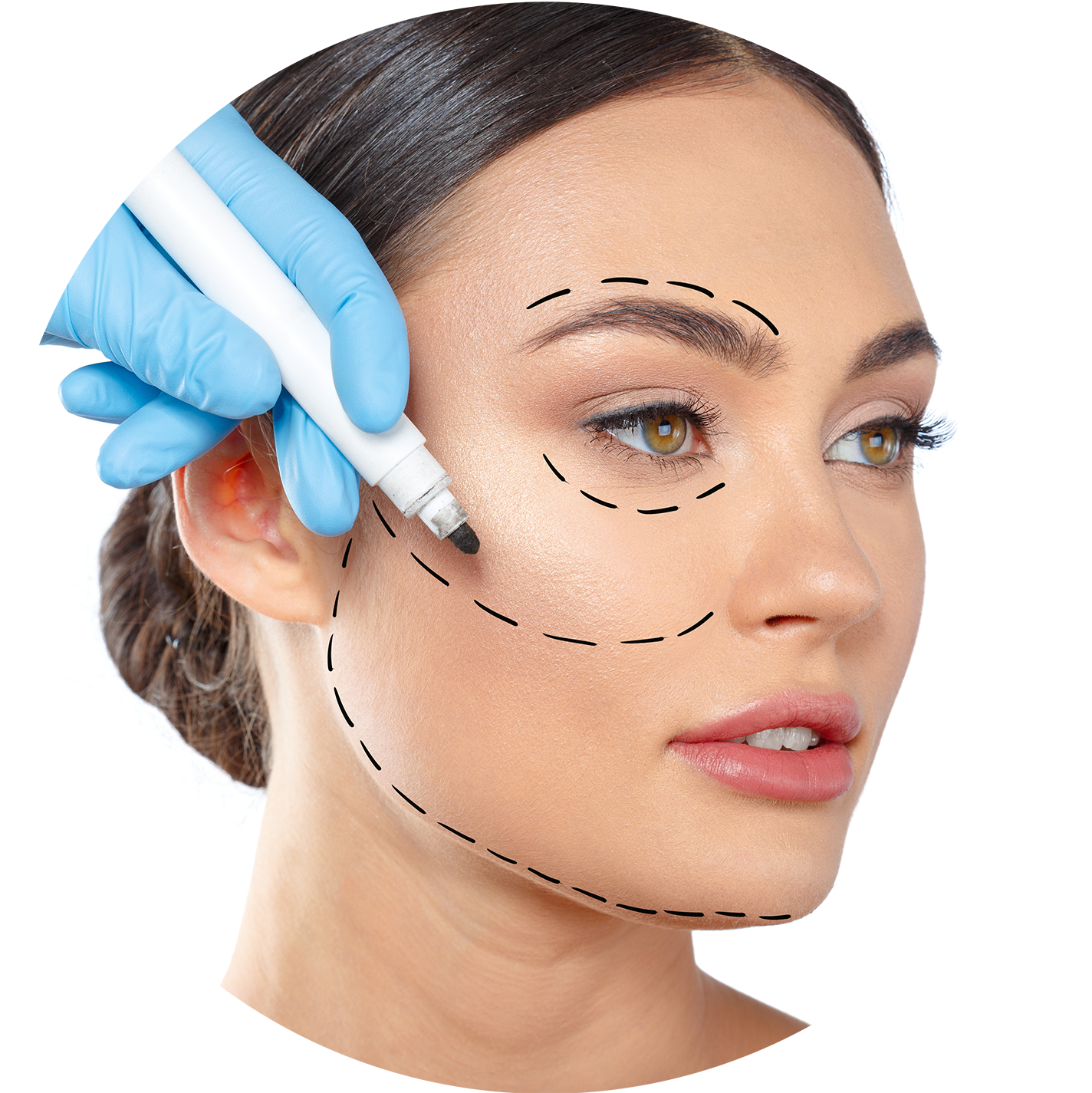 Cirugía Facial, Lifting Facial Completo o Mínimo Invasivo