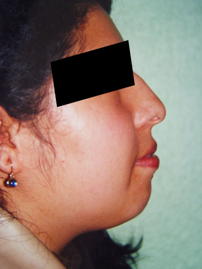 Cirugías Simultáneas