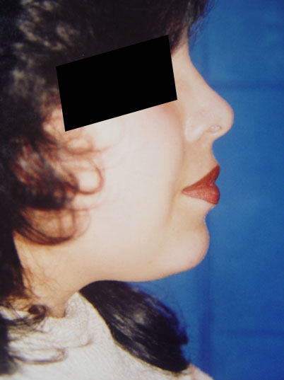 Cirugías Simultáneas