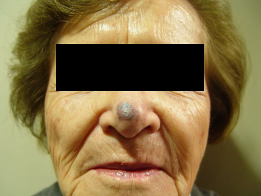 Cirugías Poco Invasivas