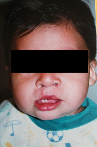 Resultado Reconstrucción Labio Leporino