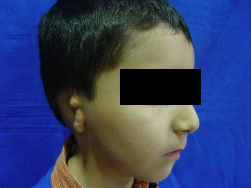 Microtia