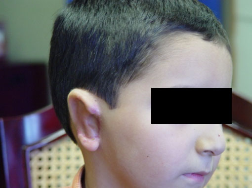 Cirugía Reconstructiva de la Oreja