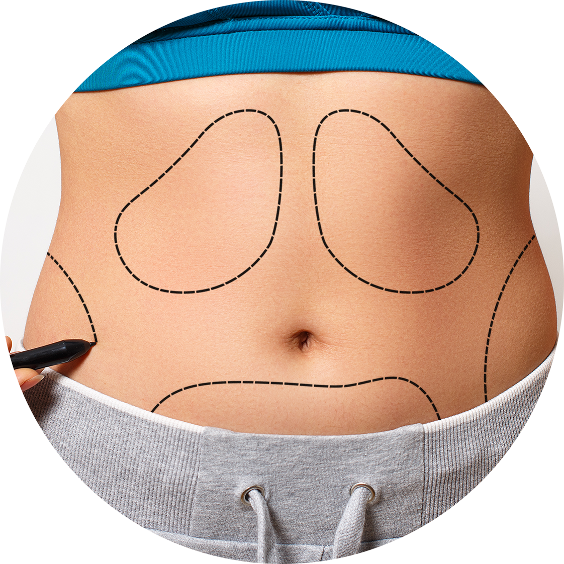 Liposucción, Lipoinyecciones, Lipoesculturas y Lipotransportación de grasa a los glúteos Liposucción, Lipoinyecciones, Lipoesculturas y Lipotransportación de grasa a los glúteos