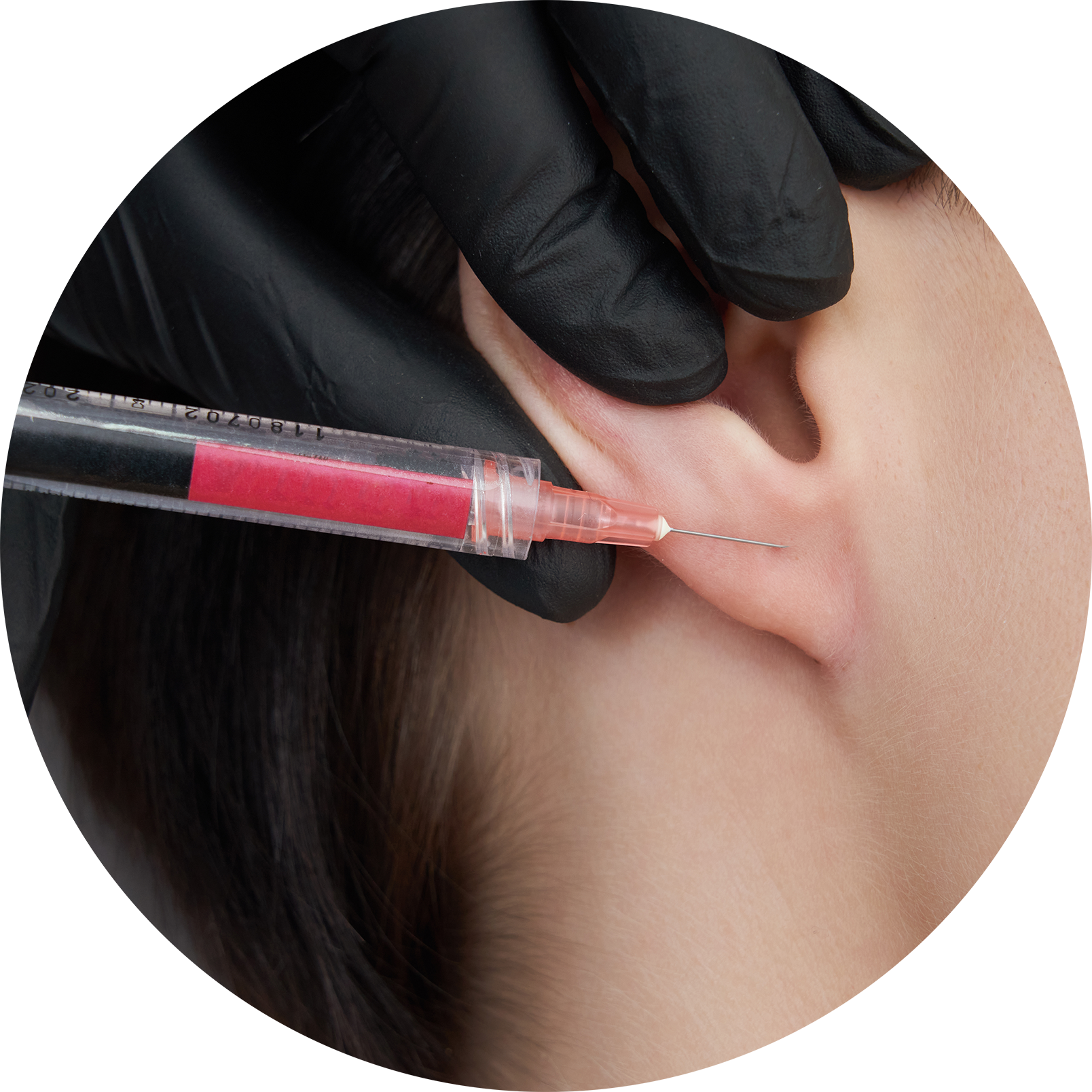 Cirugía Reconstructiva de la Oreja o Microtia Cirugía Reconstructiva de la Oreja o Microtia