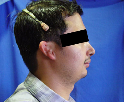 Resultado Mentoplastia