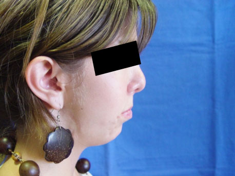 Cirugía del Mentón