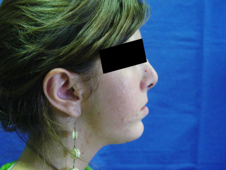 Resultado Cirugía del Mentón