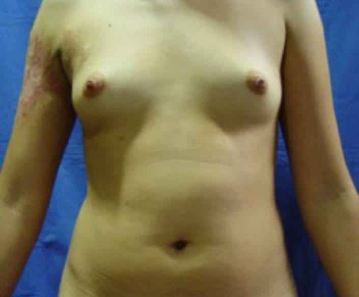 Before-Aumento Mamario