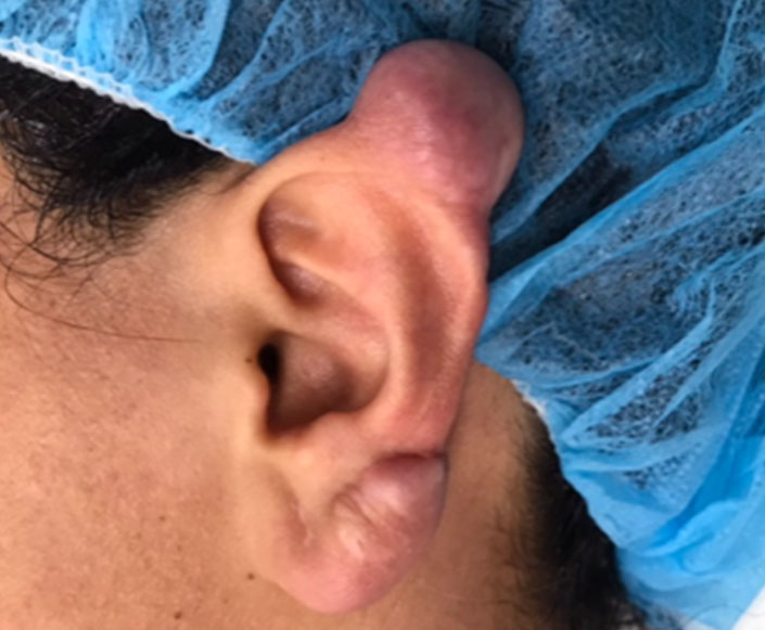 Before-Cirugía Poco Invasiva - Queloides