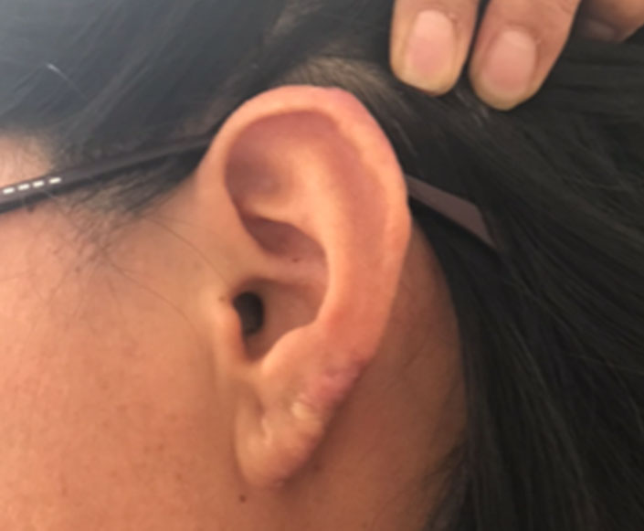 After-Cirugía Poco Invasiva - Queloides