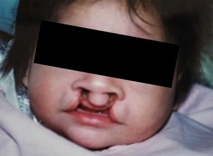 Before-Labio Leporino