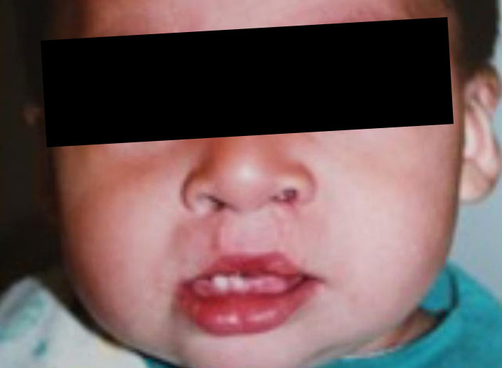 After-Labio Leporino