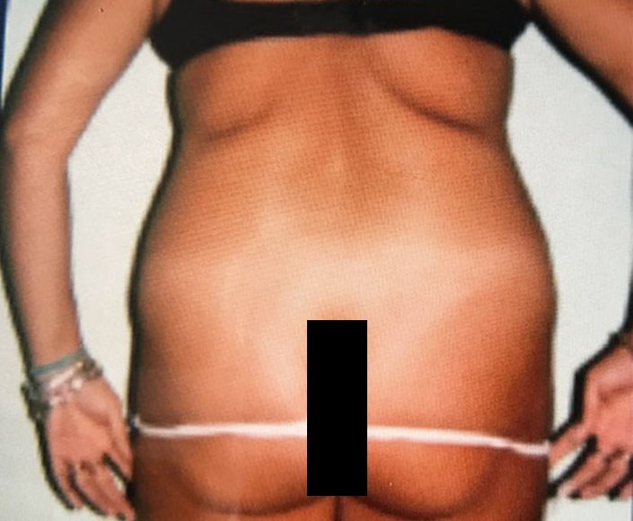 Before-Abdominoplastia, Liposucción y Lipo-inyección Glútea