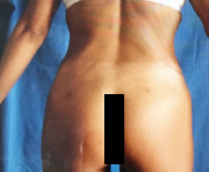 After-Abdominoplastia, Liposucción y Lipo-inyección Glútea