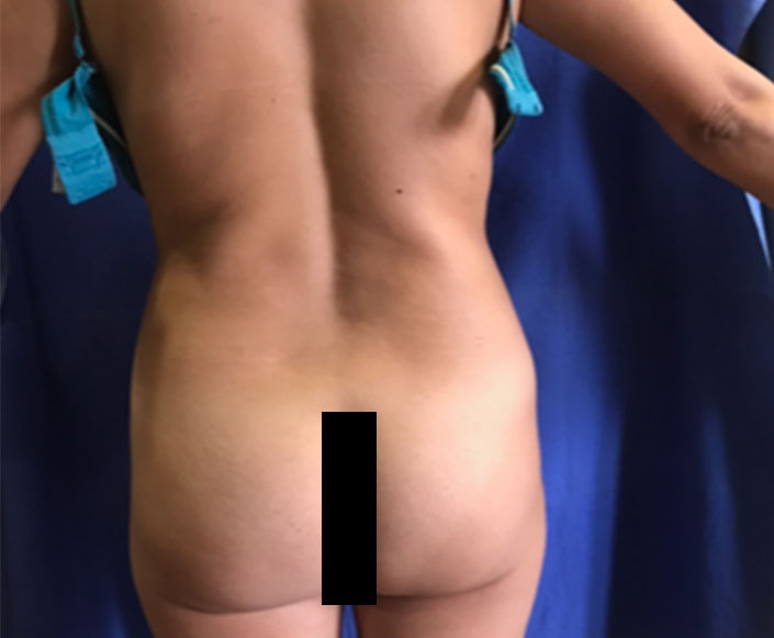 Before-Liposucción y Lipo-inyección Glútea