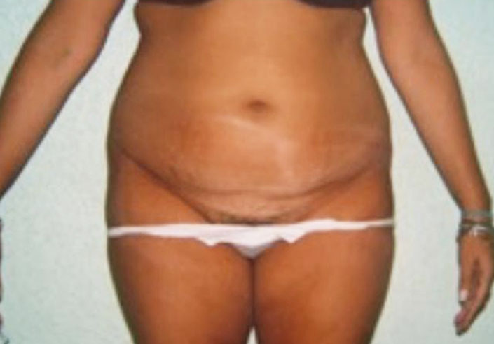 Before-Abdominoplastia