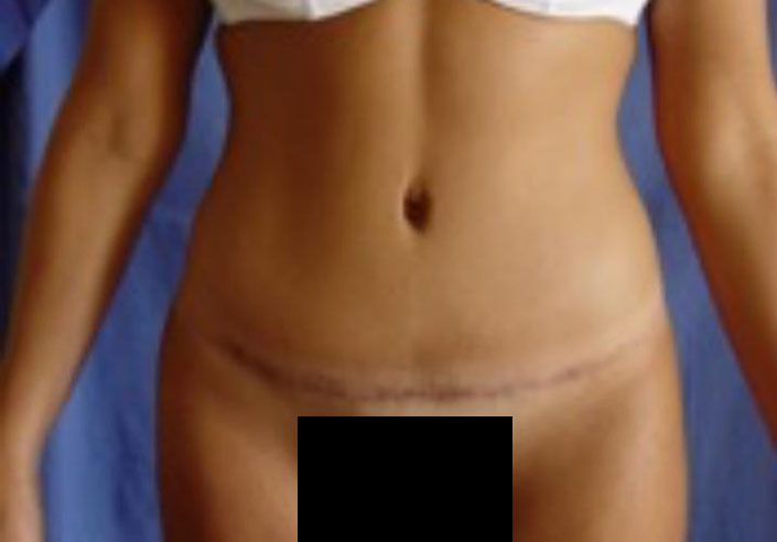 After-Abdominoplastia