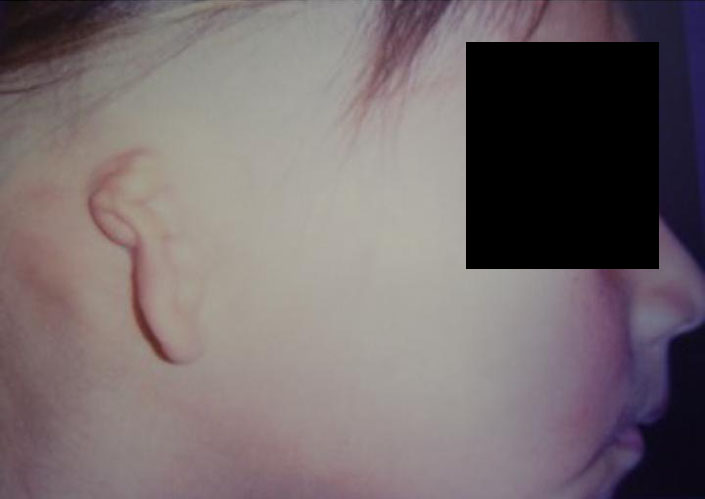 Before-Microtia 