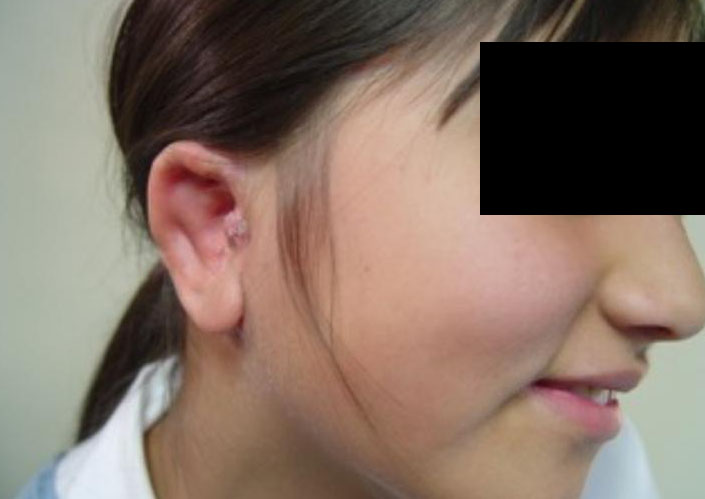After-Microtia 