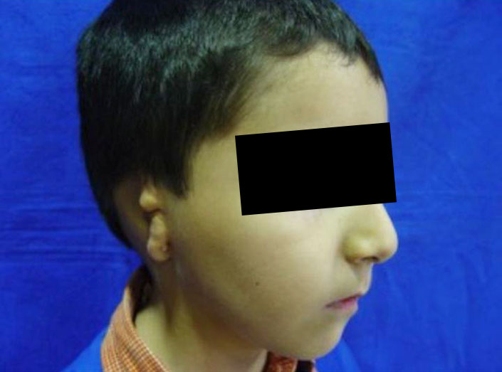 Before-Microtia 