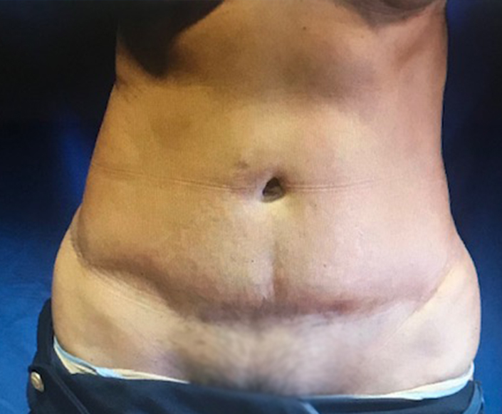 Before-Abdominoplastia