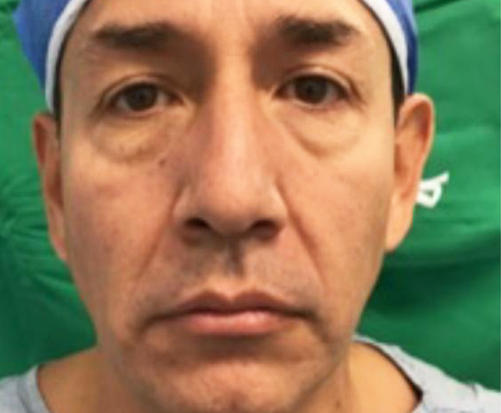 Before-Blefaroplastia