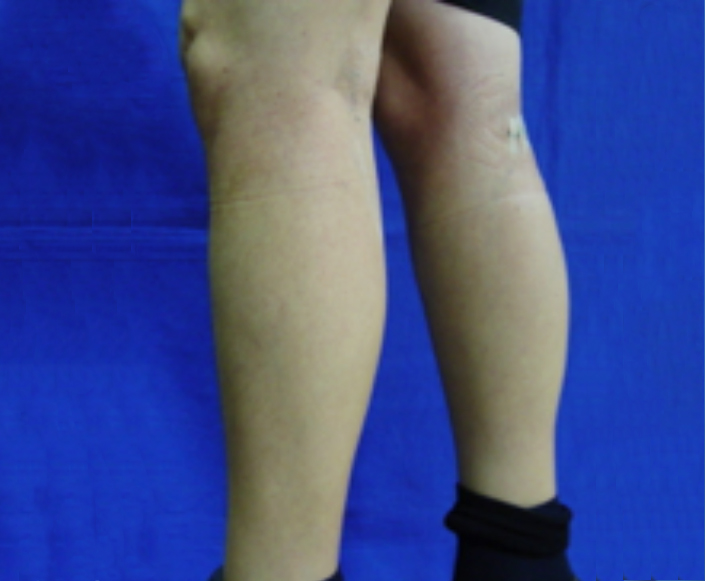 After-Implantes de Pantorrillas