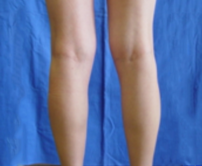 Before-Implantes de Pantorrillas