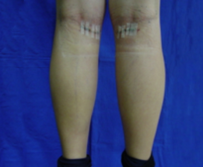 After-Implantes de Pantorrillas