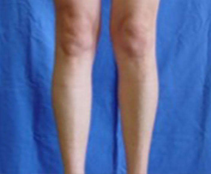 Before-Implantes de Pantorilla