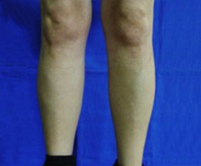 After-Implantes de Pantorilla