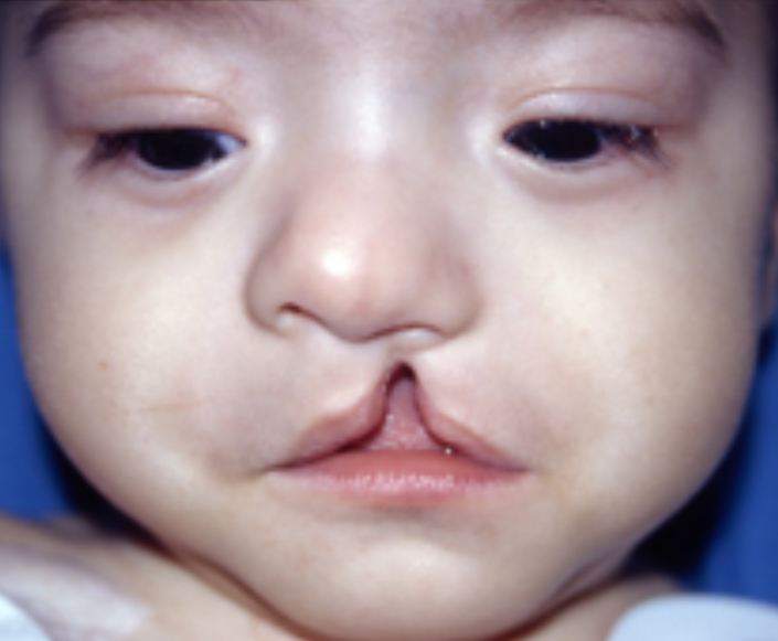 Before-Labio Leporino