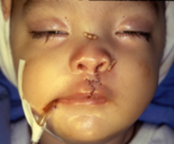 After-Labio Leporino