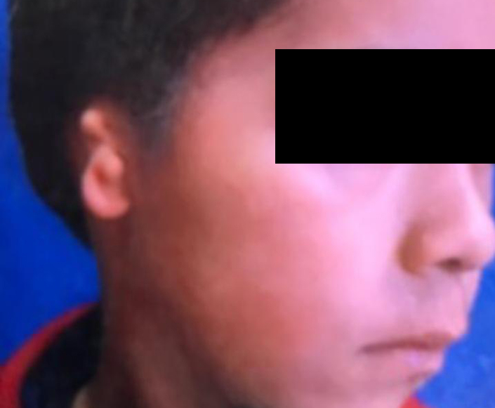 Before-Microtia 