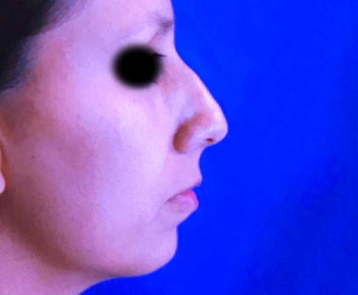 Before-Rinoplastia más Aumento de Mentón