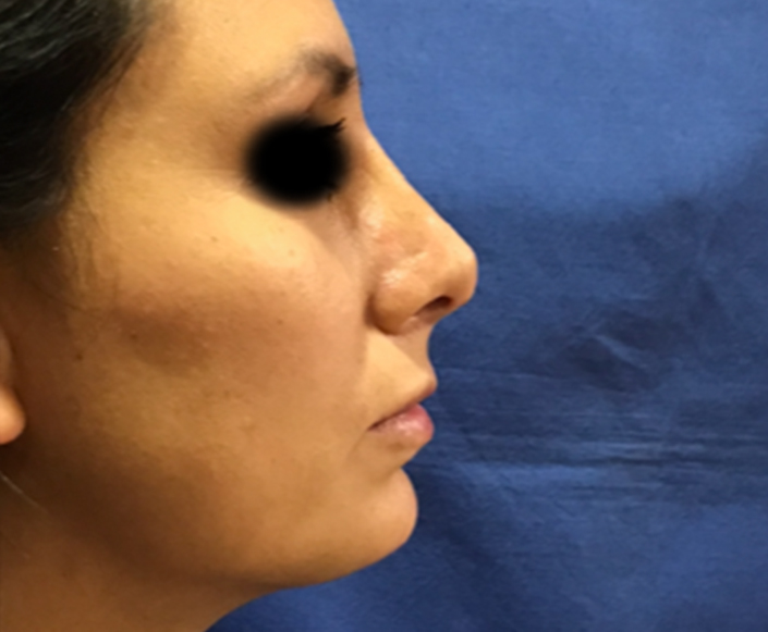 After-Rinoplastia más Aumento de Mentón