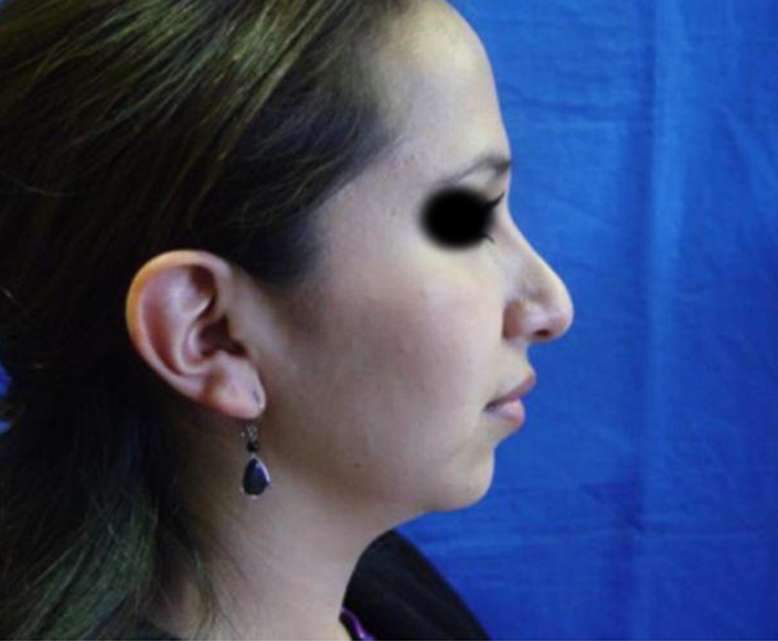 Before-Rinoplastia más Aumento de Mentón