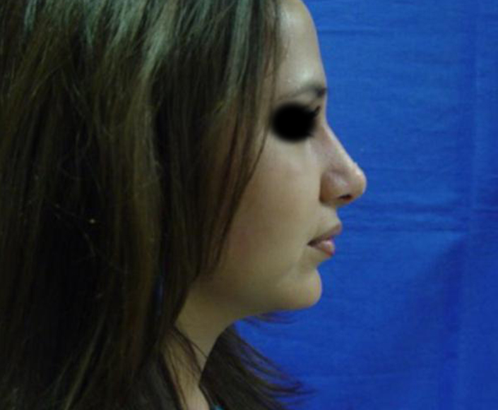 After-Rinoplastia más Aumento de Mentón