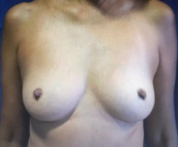 Before-Aumento Mamario